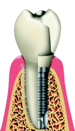 Implant3